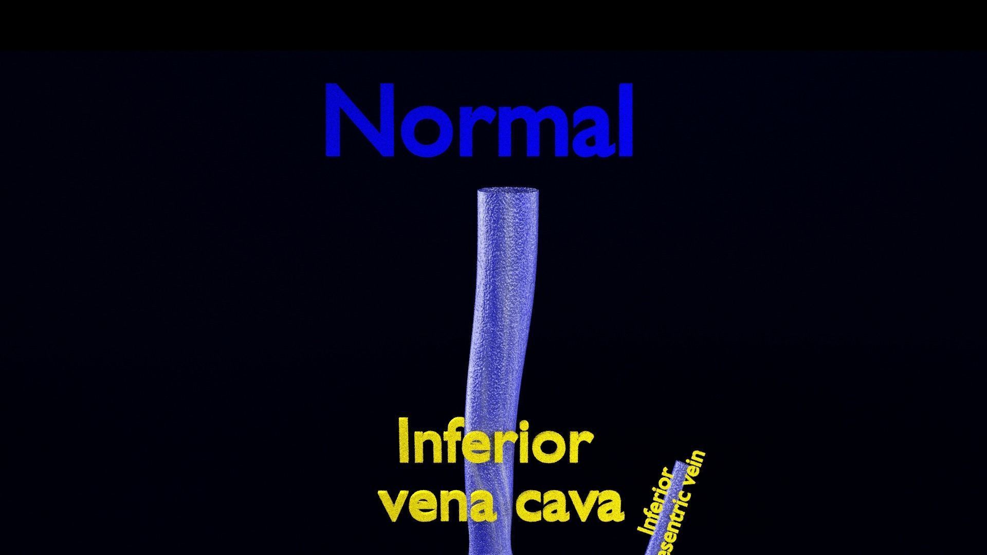 hemorrhoids piles 3D model_4