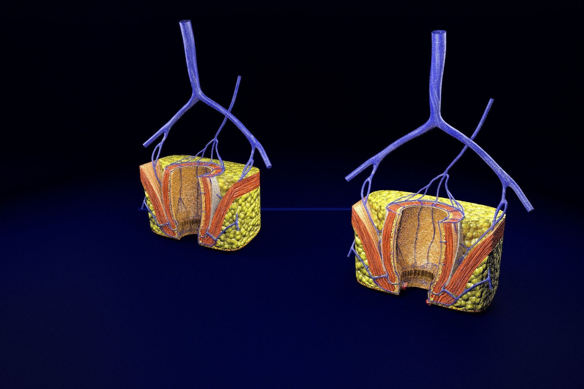 hemorrhoids piles 3D model_92