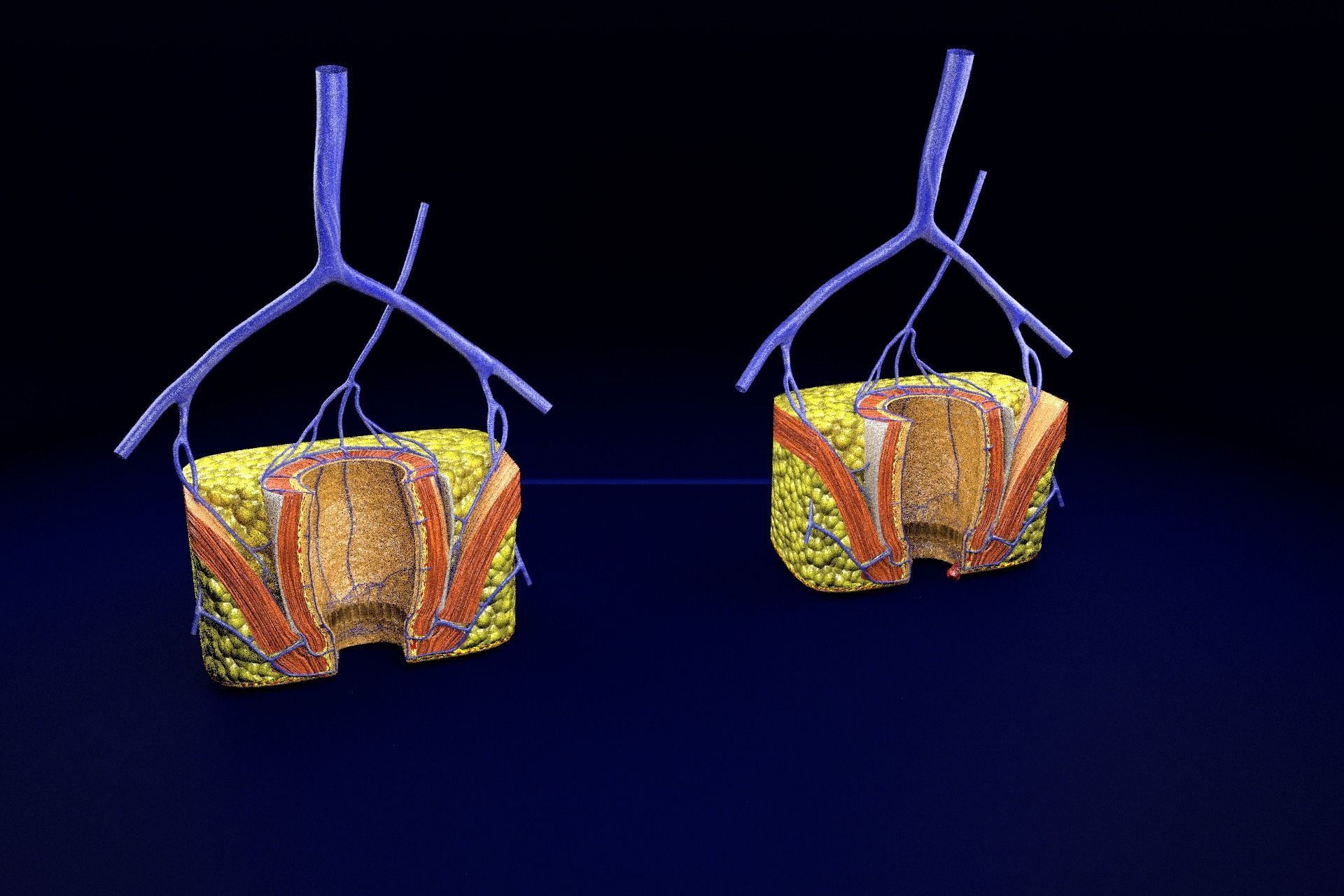 hemorrhoids piles 3D model_47