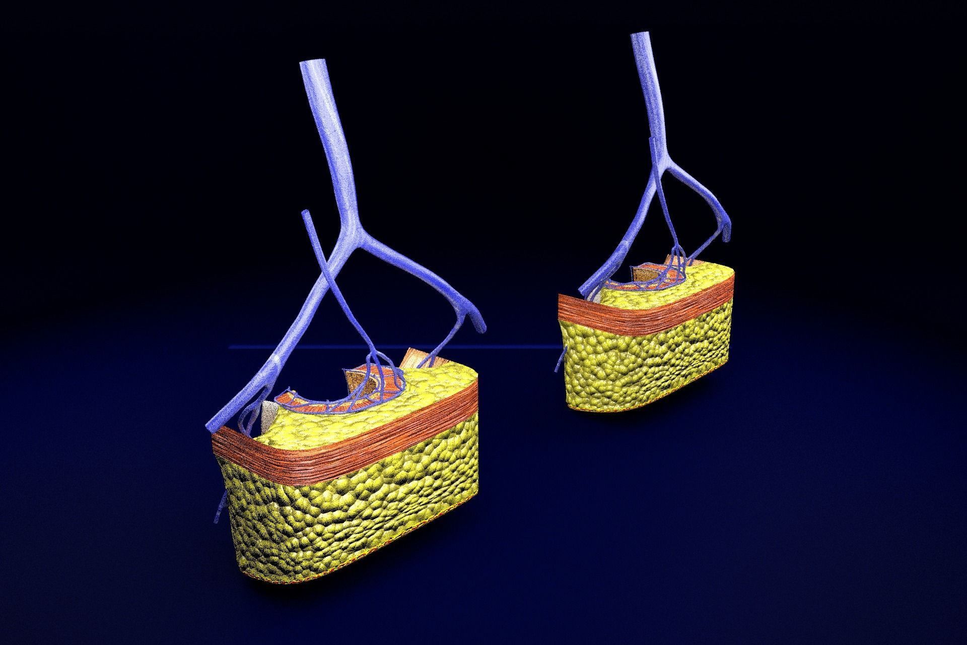 hemorrhoids piles 3D model_83