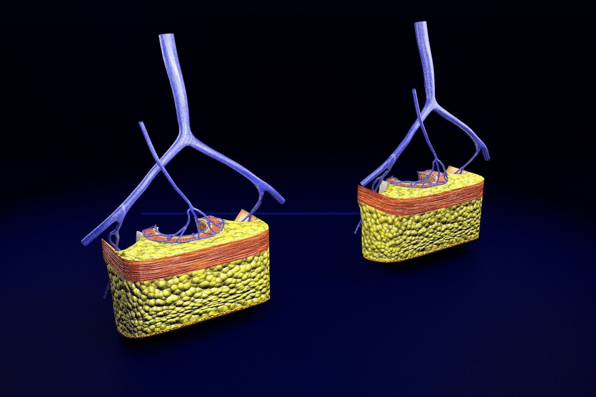 hemorrhoids piles 3D model_72