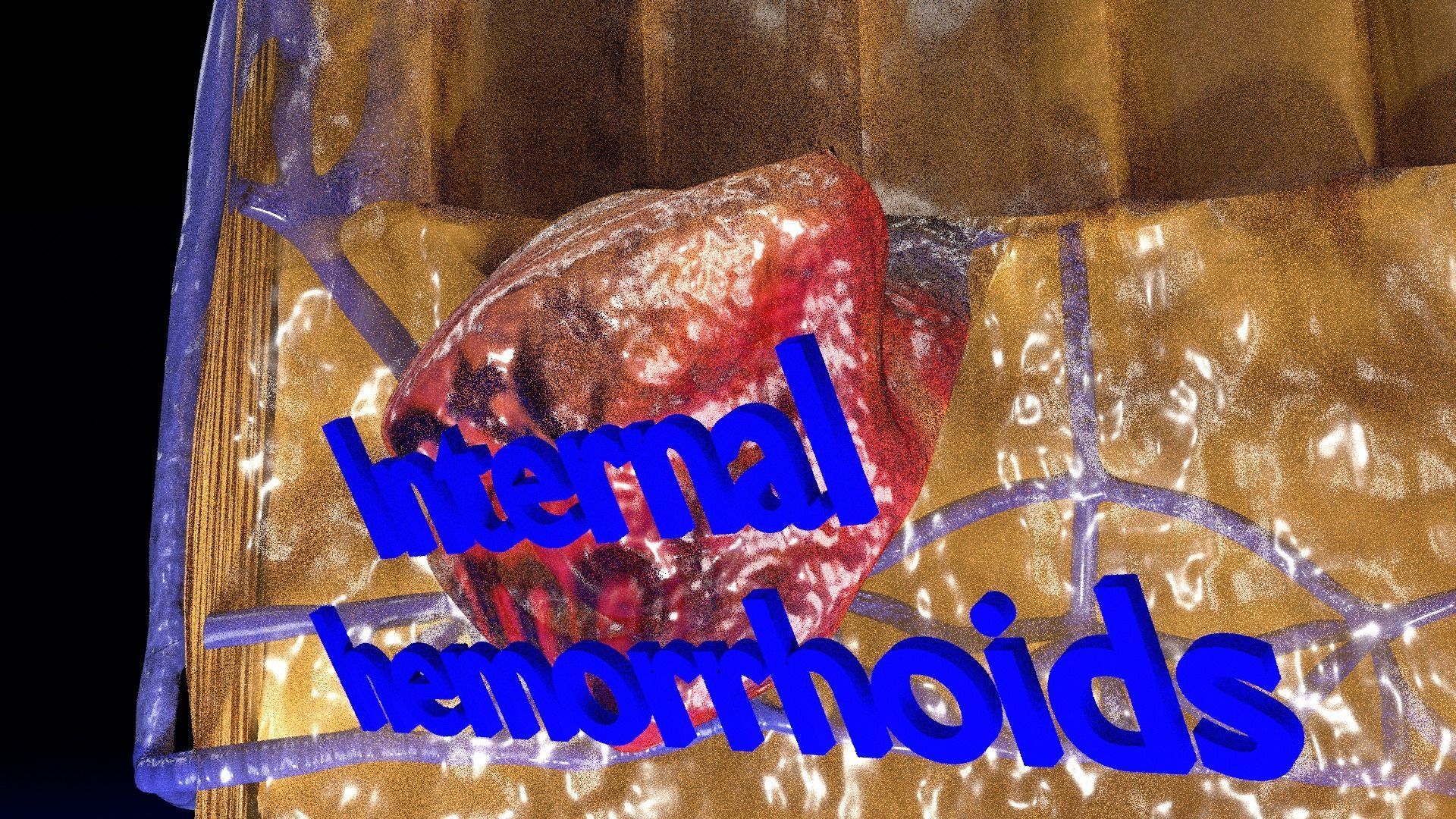 hemorrhoids piles 3D model_14
