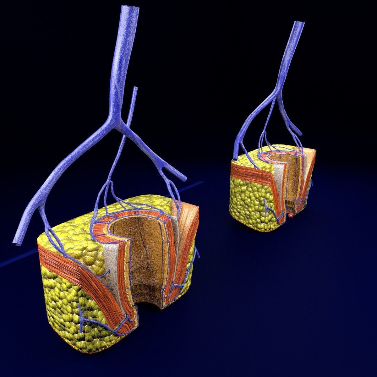 hemorrhoids piles 3D model_2