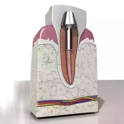 Dental Implant 3D model