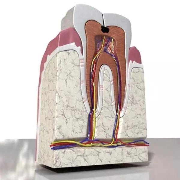 Cracked Tooth High Detail 3D model