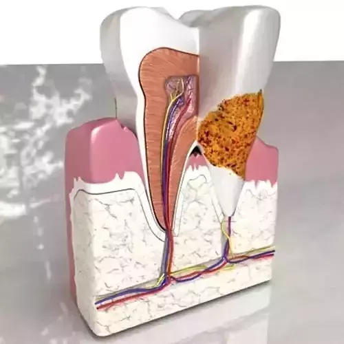 Tooth Dental Plaque High Detail 3D model