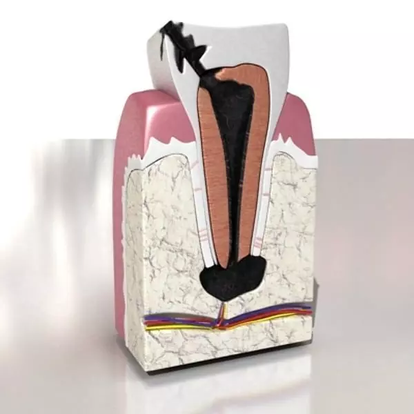 Decayed Tooth 3D model