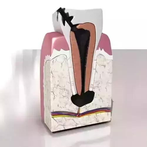 Decayed Tooth 3D model