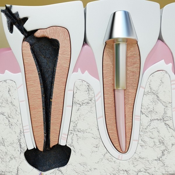 Teeth Pathologies High Detail 3D model_5