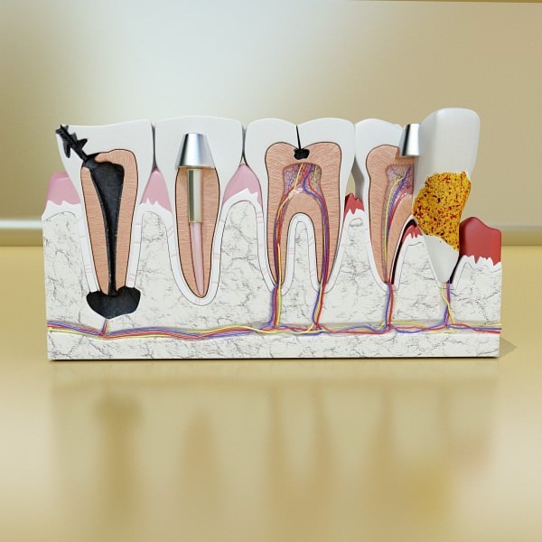 Teeth Pathologies High Detail 3D model_2