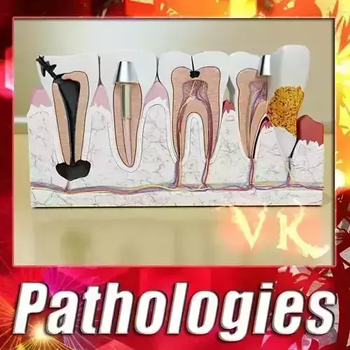 Teeth Pathologies High Detail