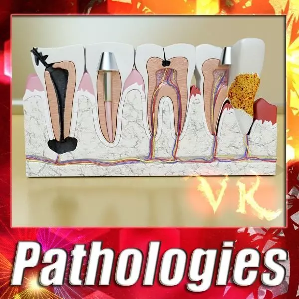 Teeth Pathologies High Detail 3D model_0