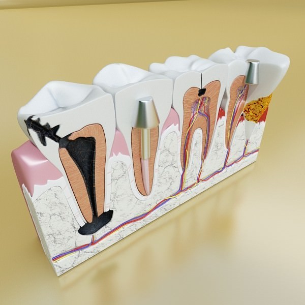 Teeth Pathologies High Detail 3D model_3