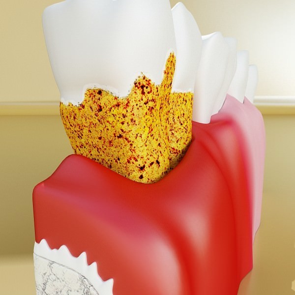 Teeth Pathologies High Detail 3D model_7