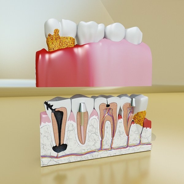 Teeth Pathologies High Detail 3D model_1