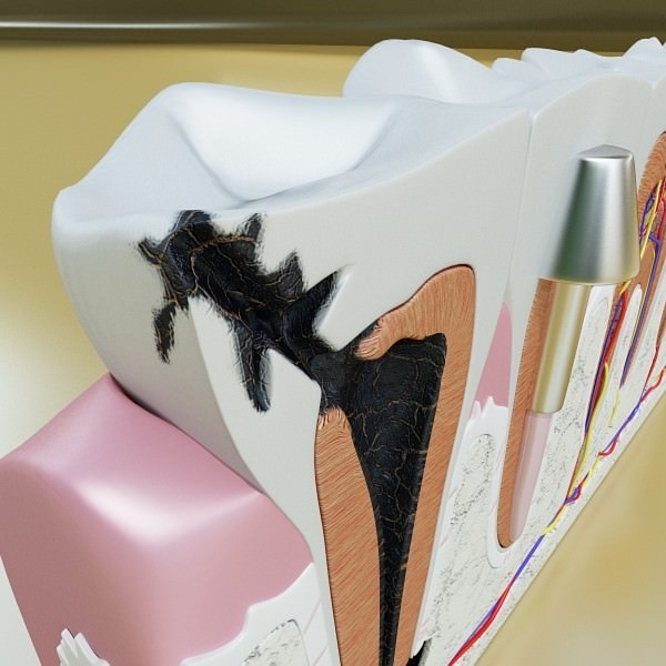 Teeth Pathologies High Detail 3D model_9