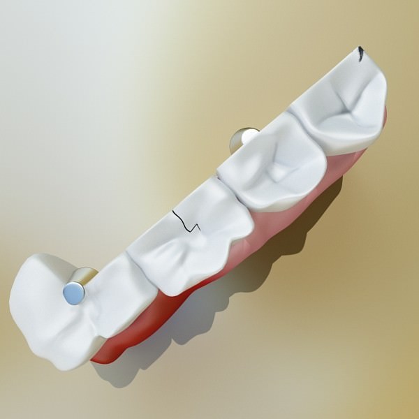 Teeth Pathologies High Detail 3D model_4