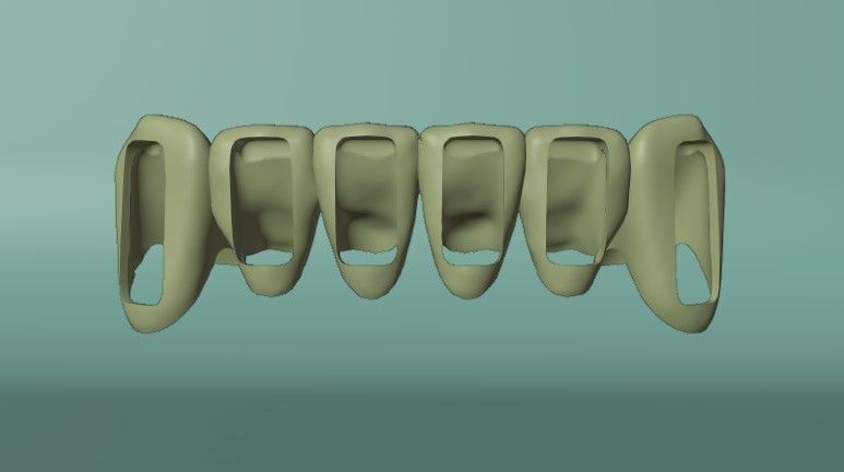 Lower Grillz - gold teeth 3D model 3D model_5