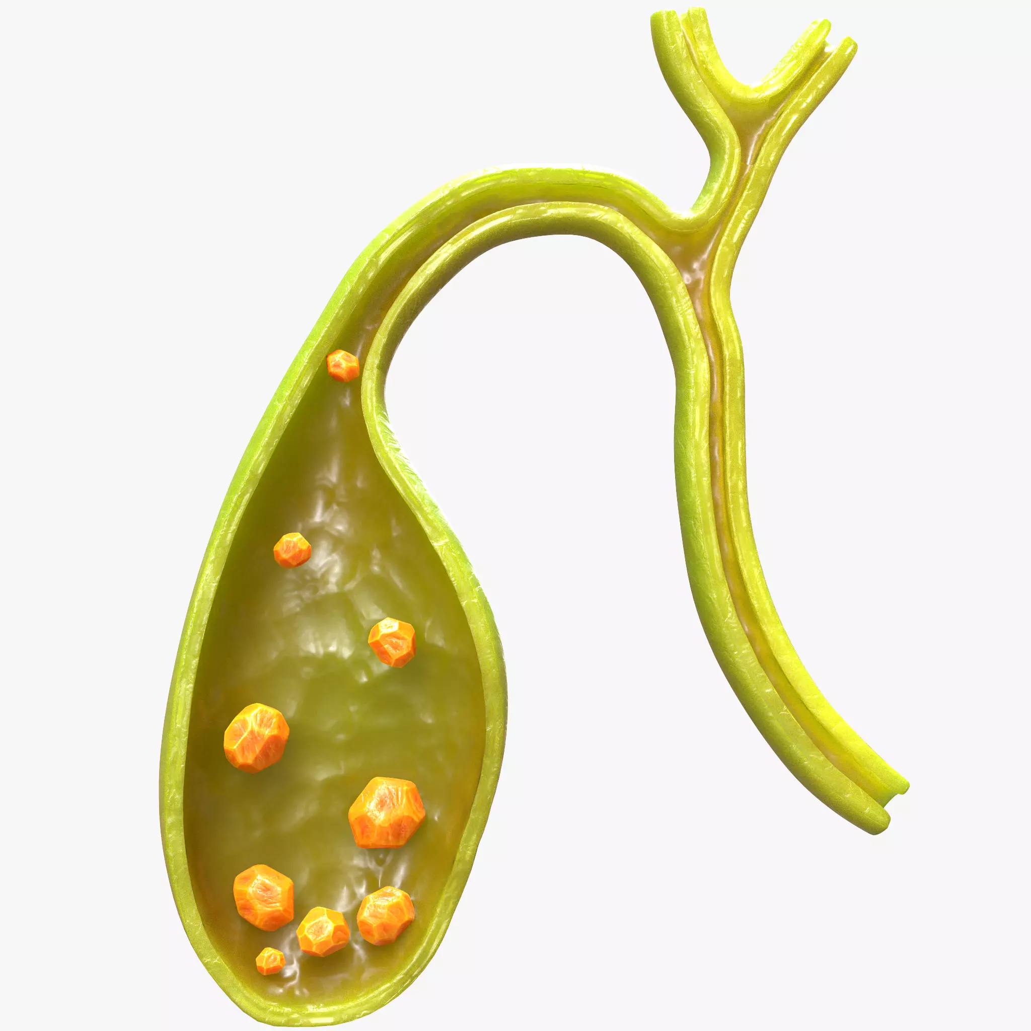 Gallbladder with Gallstones 3D model