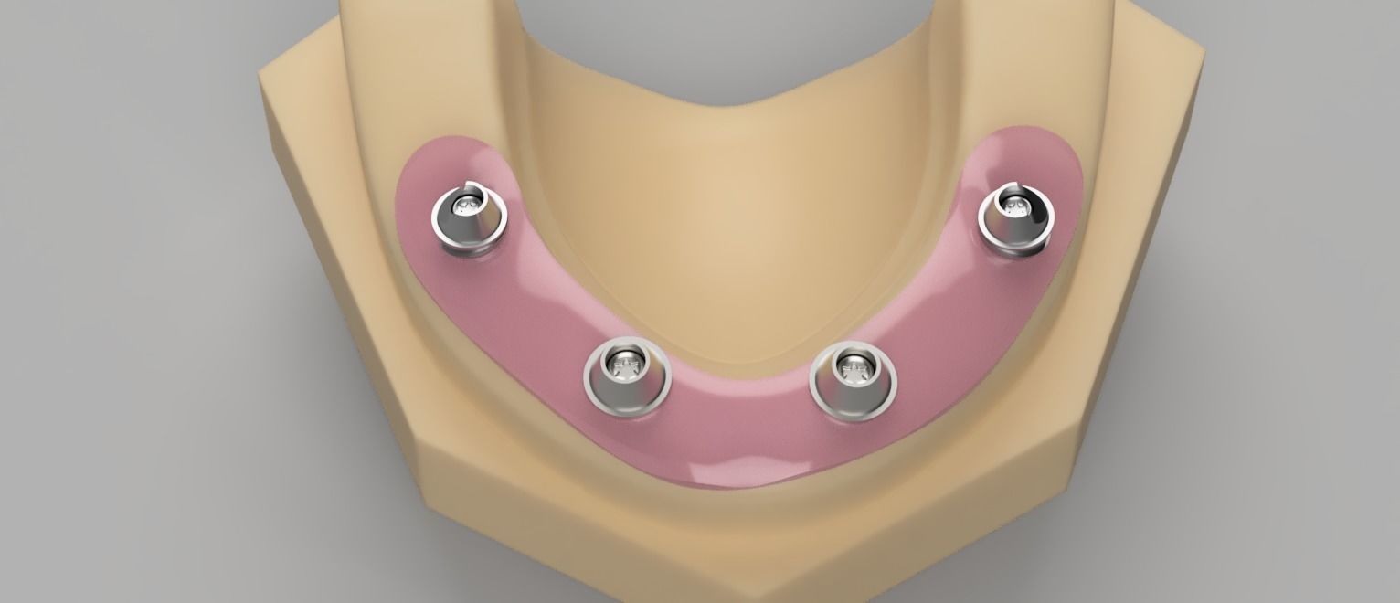 SCREW RETAINED ABUTMENTS 3D model_3