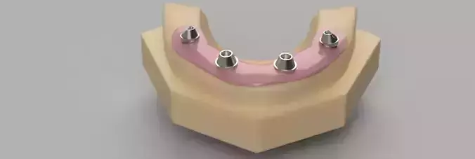 SCREW RETAINED ABUTMENTS