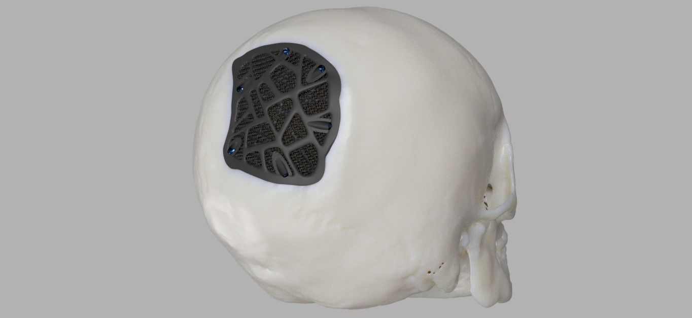 Trabecular titanium prosthesis 3D print model_4