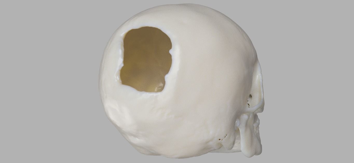 Trabecular titanium prosthesis 3D print model_5