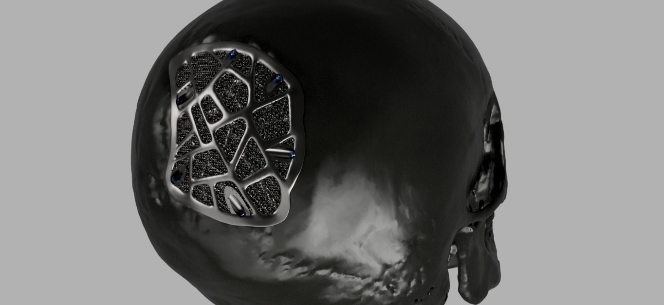 Trabecular titanium prosthesis 3D print model_3