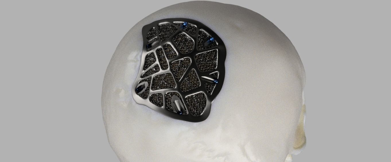 Trabecular titanium prosthesis 3D print model_1