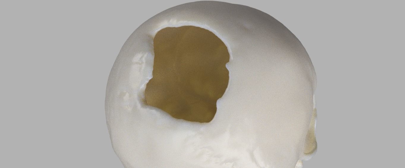 Trabecular titanium prosthesis 3D print model_2