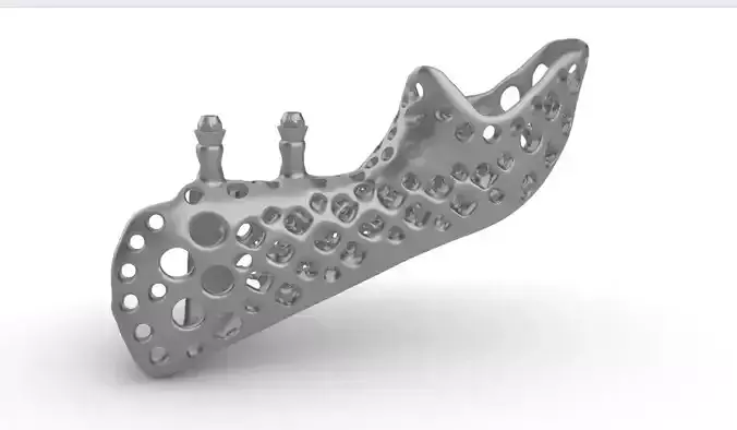 Medical implant for the reconstruction of the lower jaw 3D print model