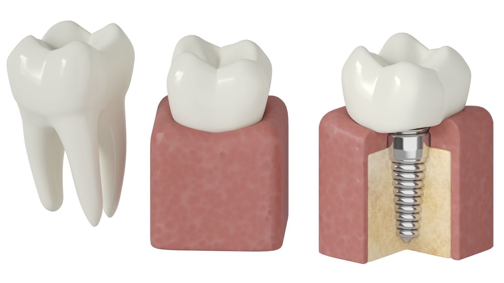 Tooth decay stages cavity caries 3D model_1