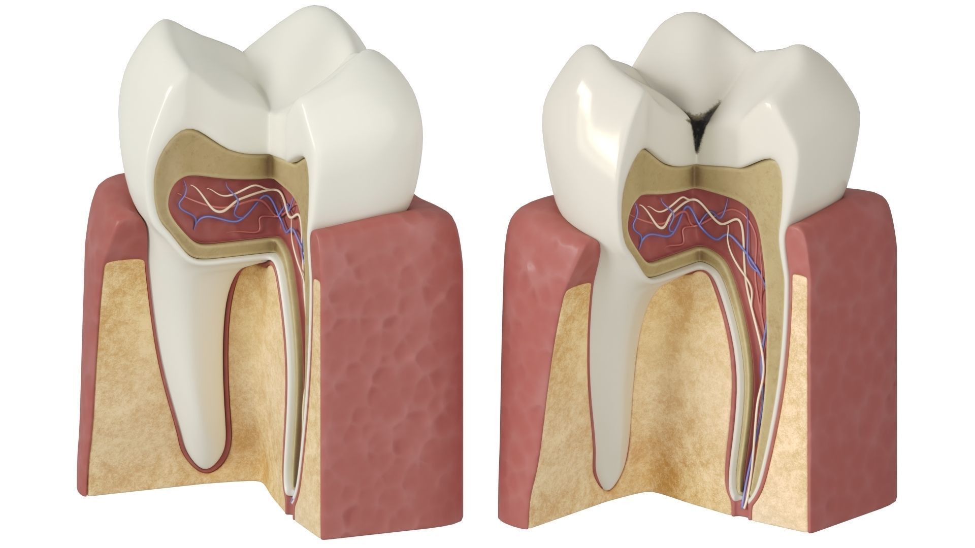 Tooth decay stages cavity caries 3D model_5