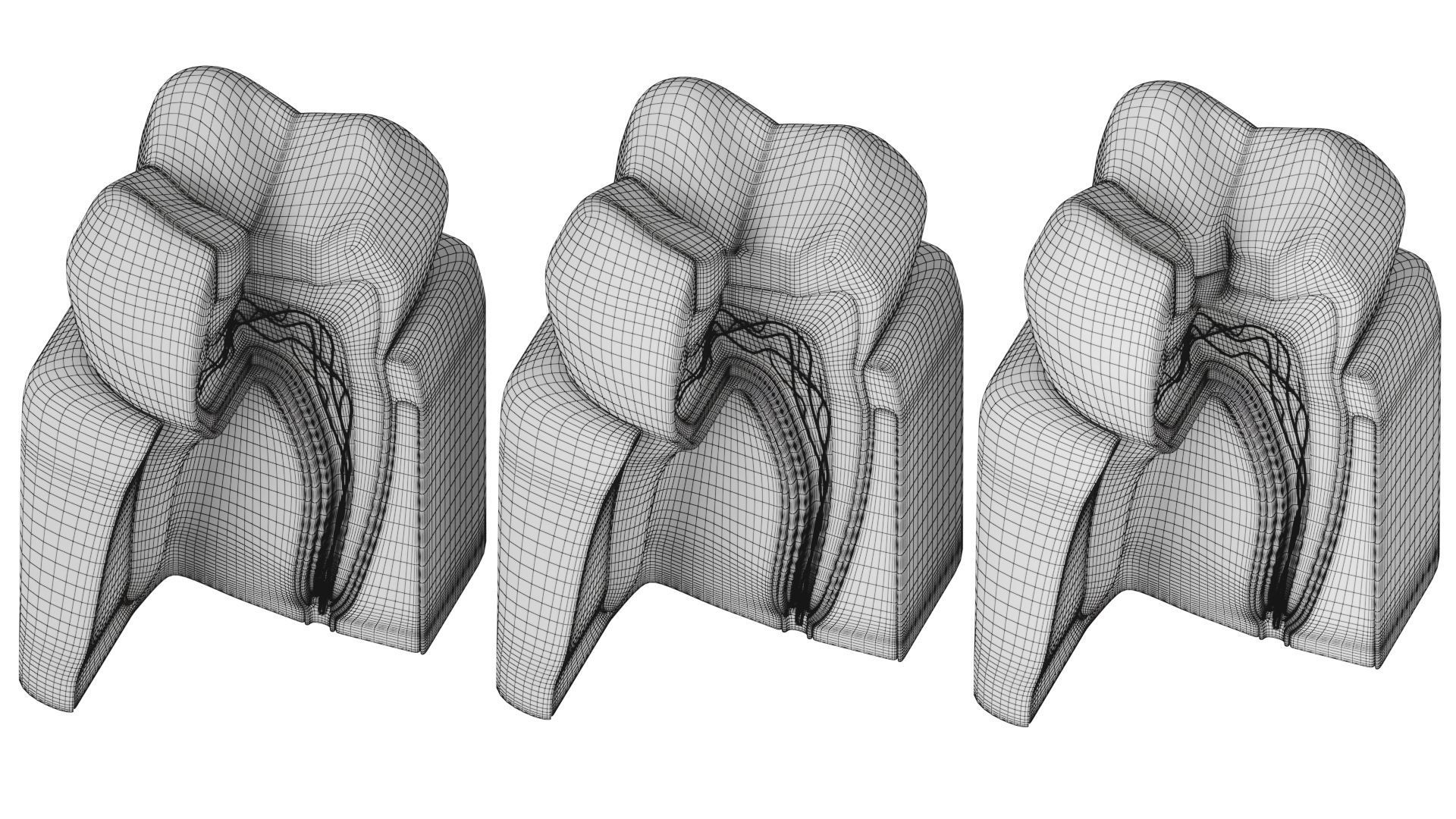 Tooth decay stages cavity caries 3D model_15