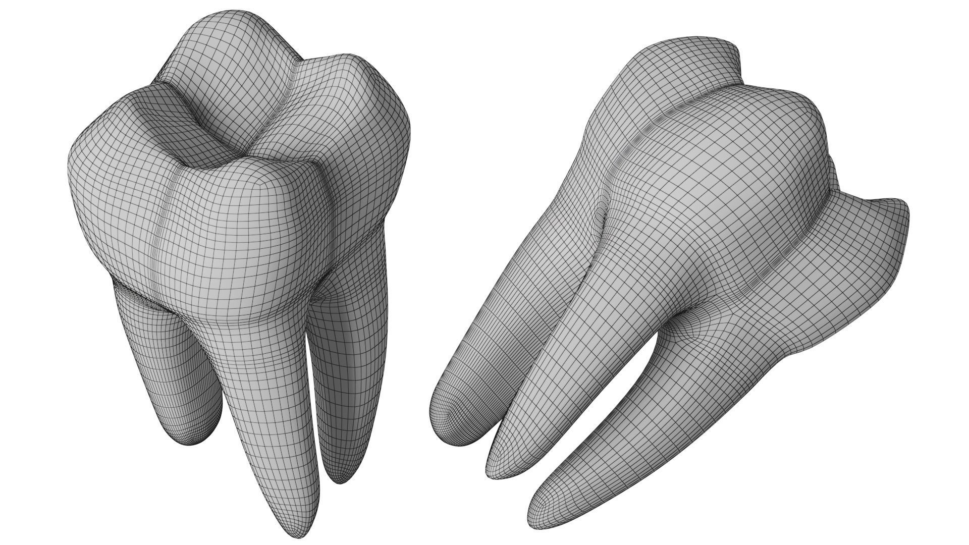 Tooth decay stages cavity caries 3D model_11