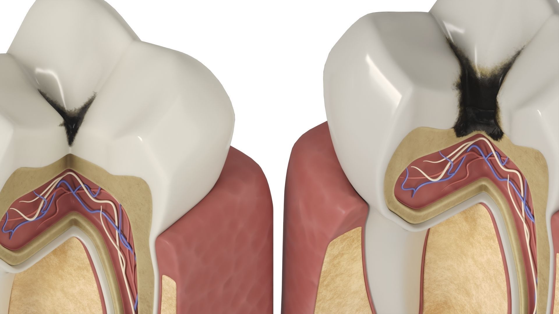 Tooth decay stages cavity caries 3D model_7