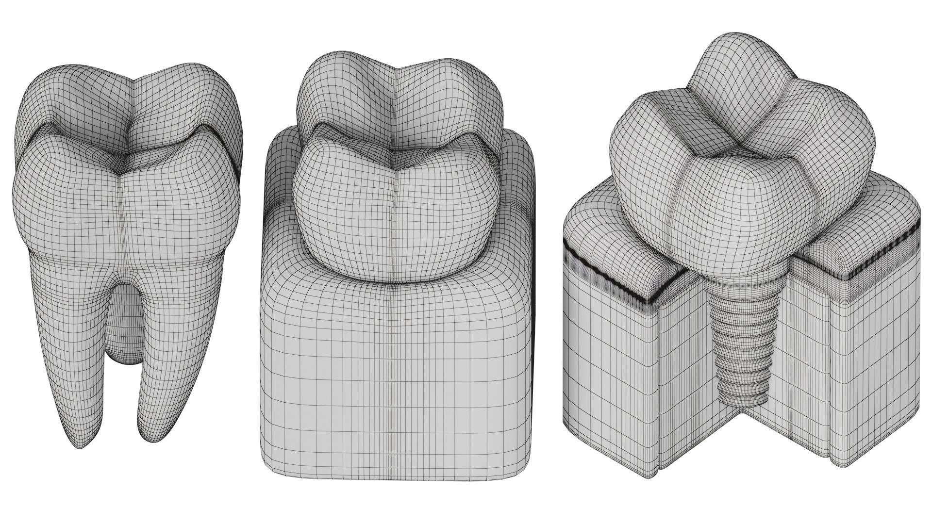 Tooth decay stages cavity caries 3D model_14