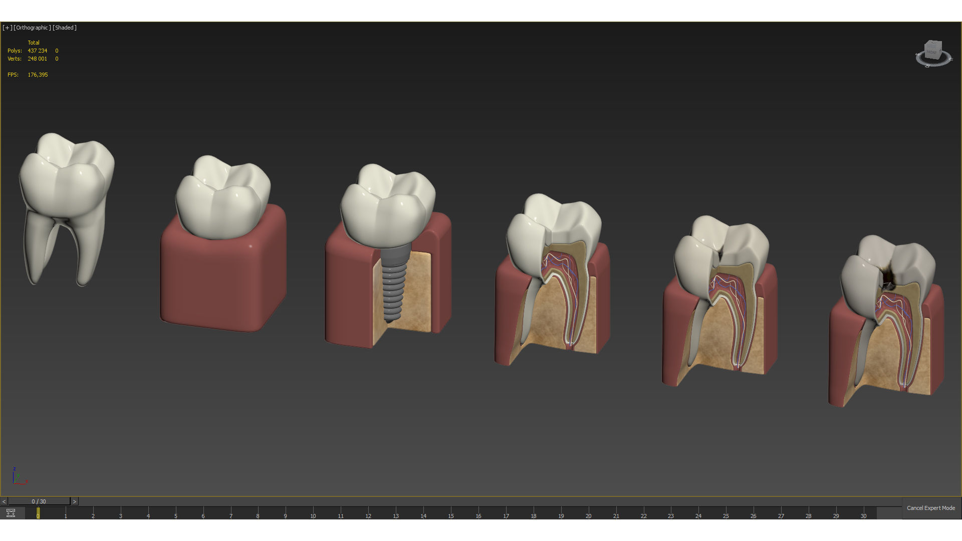 Tooth decay stages cavity caries 3D model_10