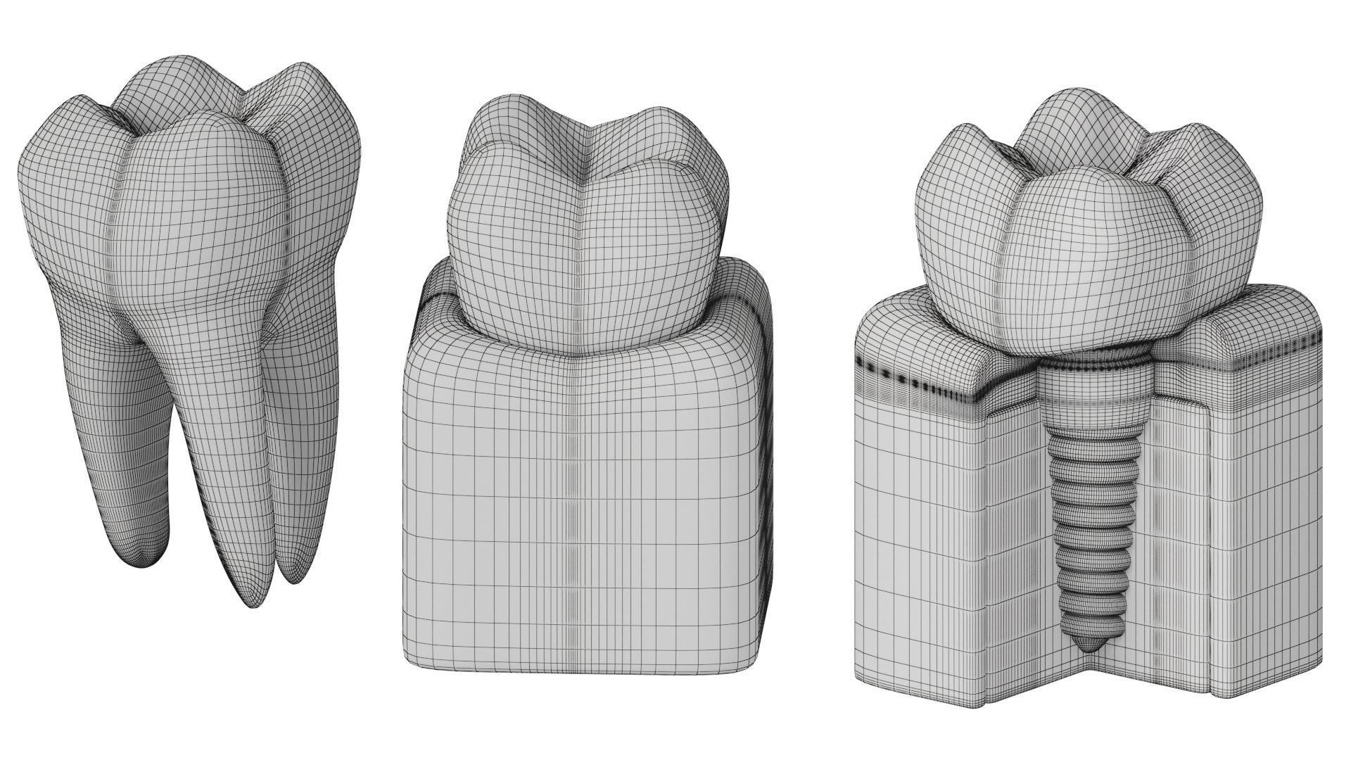 Tooth decay stages cavity caries 3D model_12