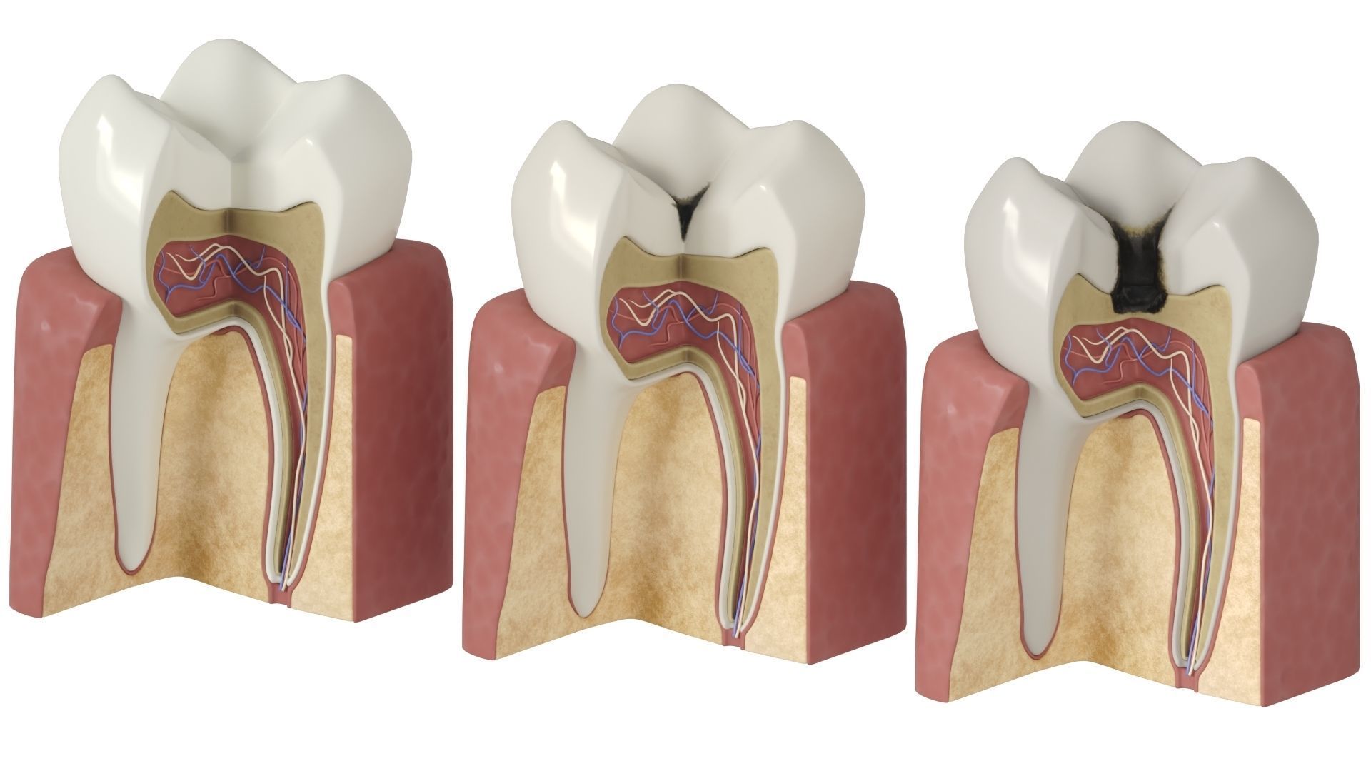 Tooth decay stages cavity caries 3D model_2