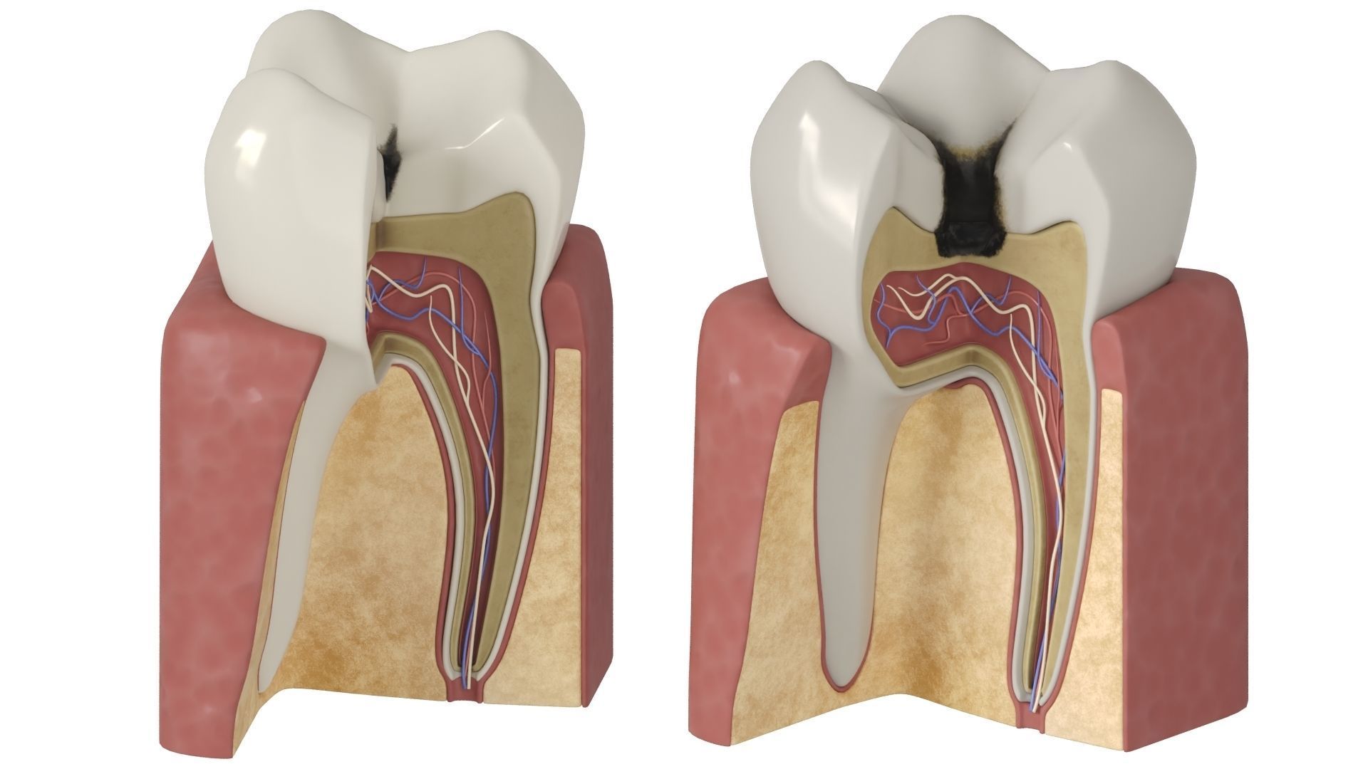 Tooth decay stages cavity caries 3D model_6