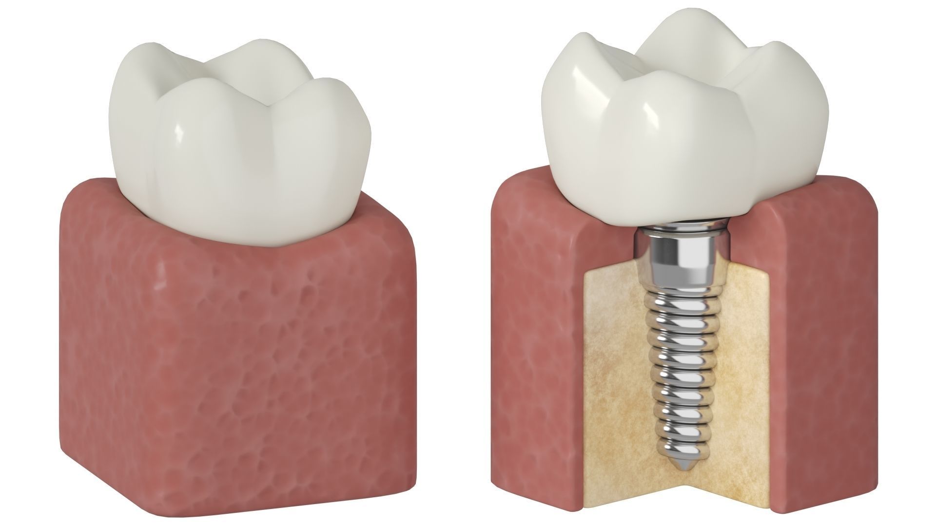 Tooth decay stages cavity caries 3D model_4