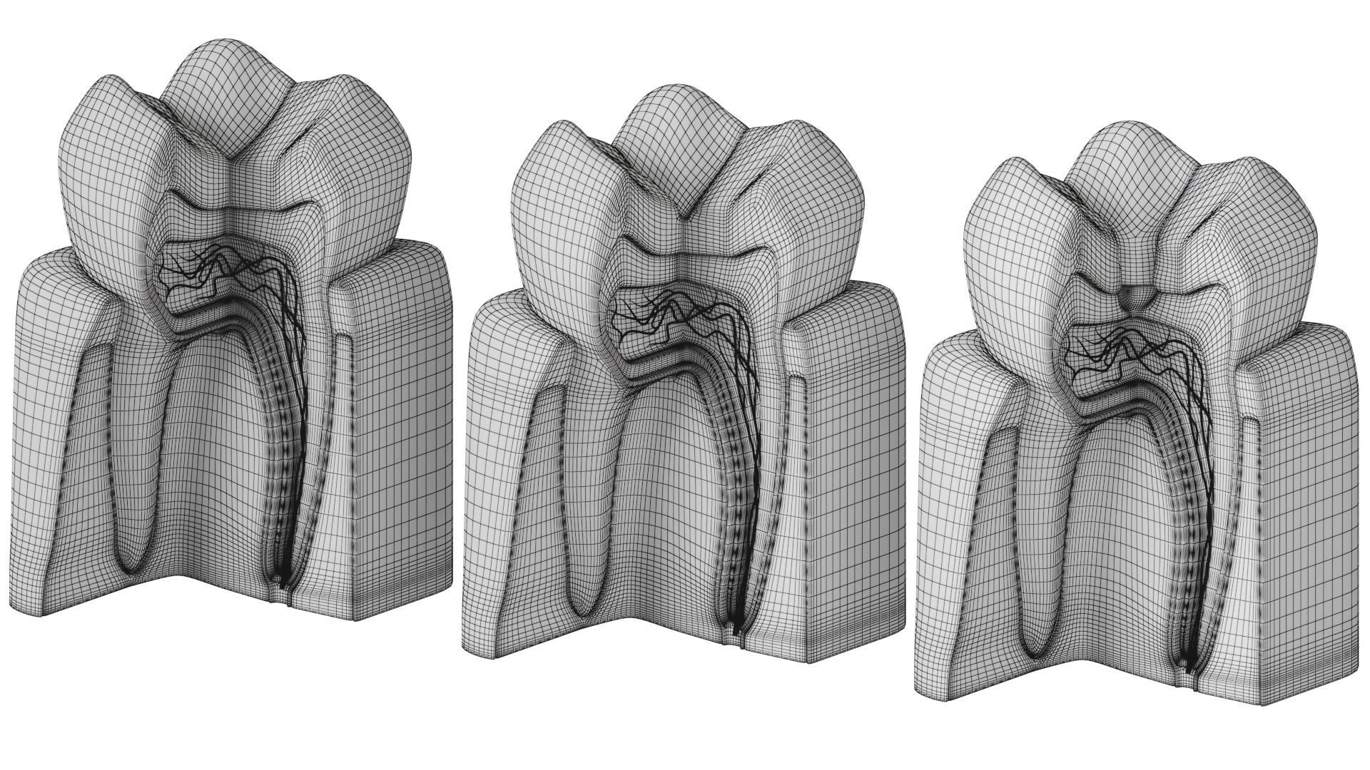 Tooth decay stages cavity caries 3D model_13