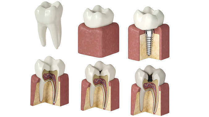 Tooth decay stages cavity caries 3D model