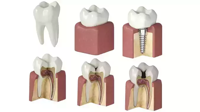 Tooth decay stages cavity caries 3D model