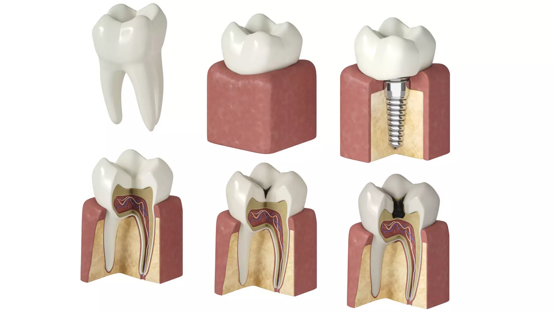 Tooth decay stages cavity caries 3D model_0