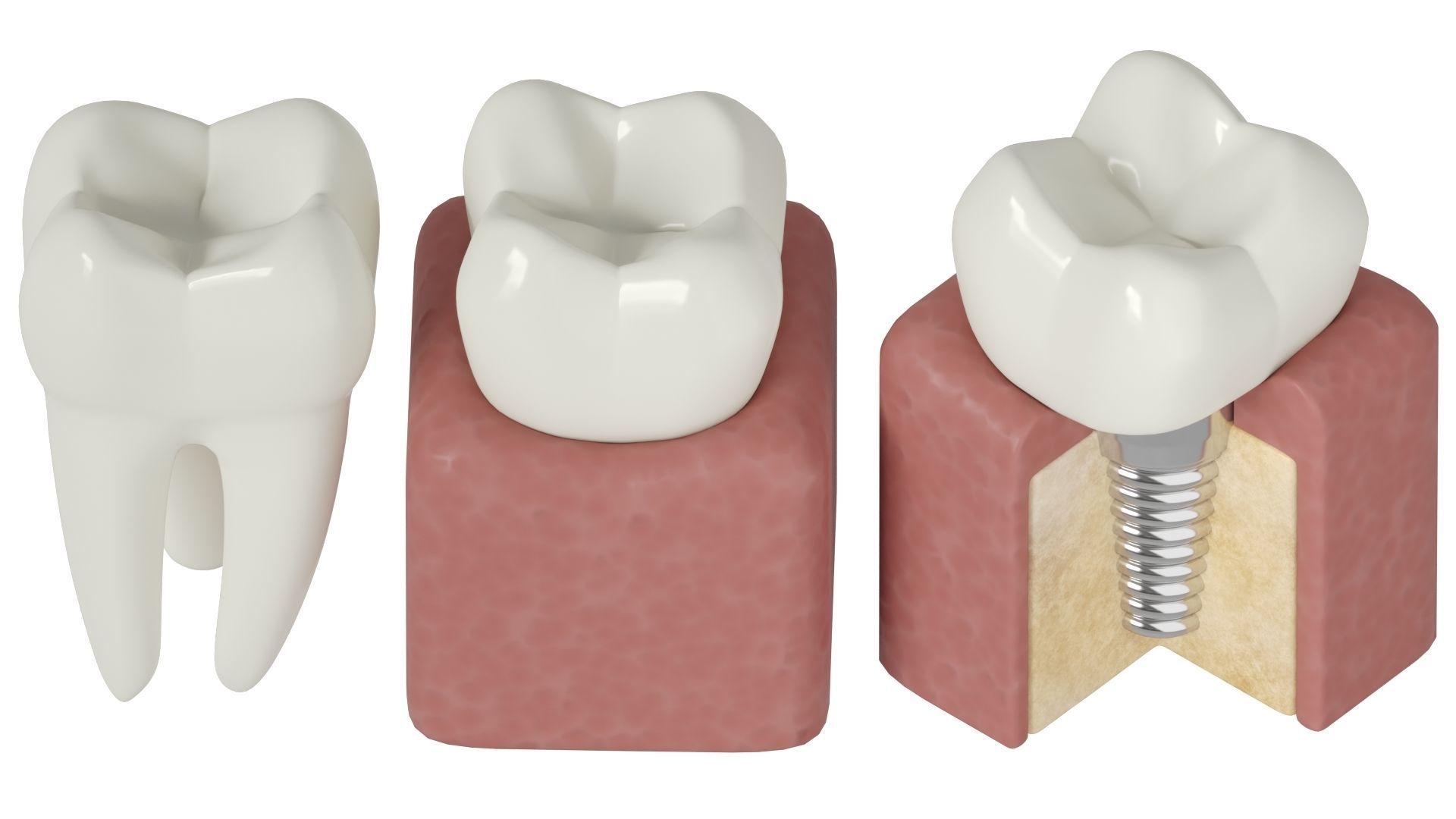 Tooth decay stages cavity caries 3D model_8