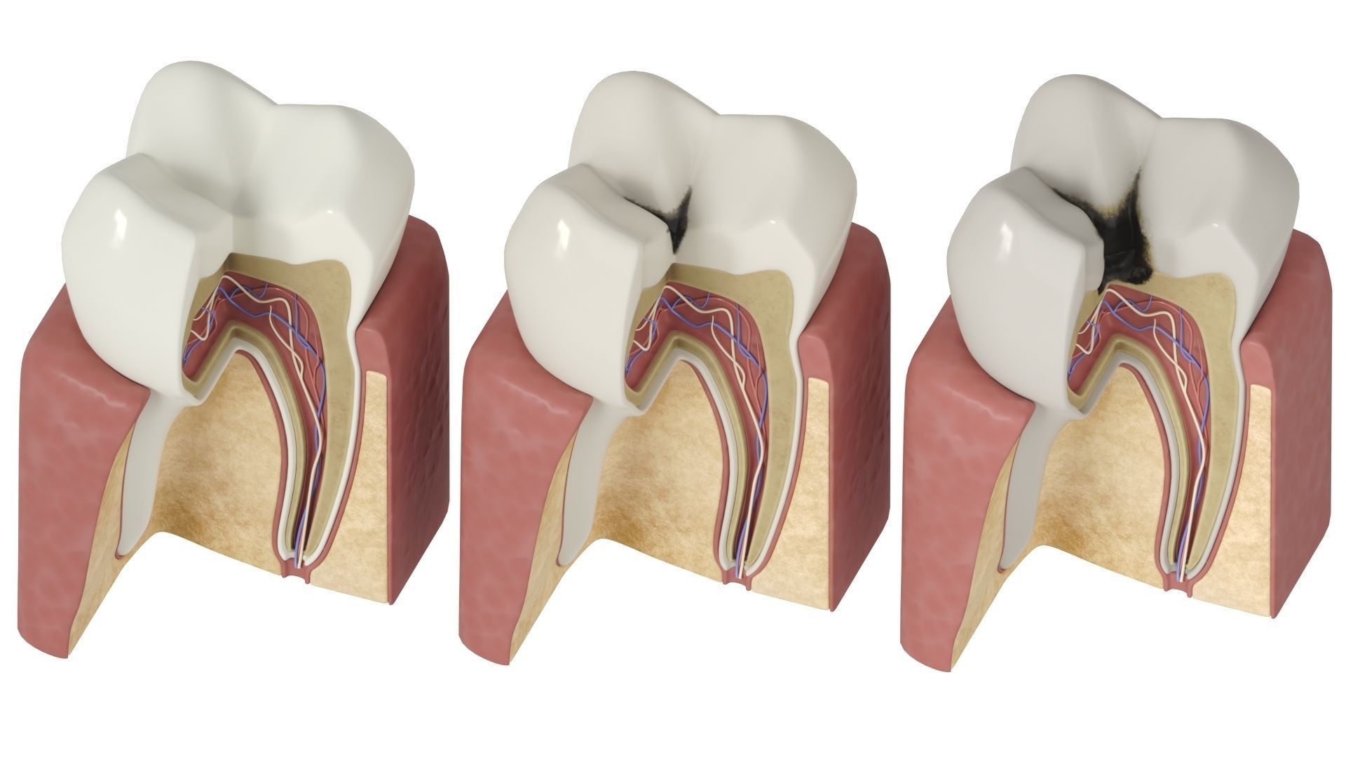 Tooth decay stages cavity caries 3D model_9