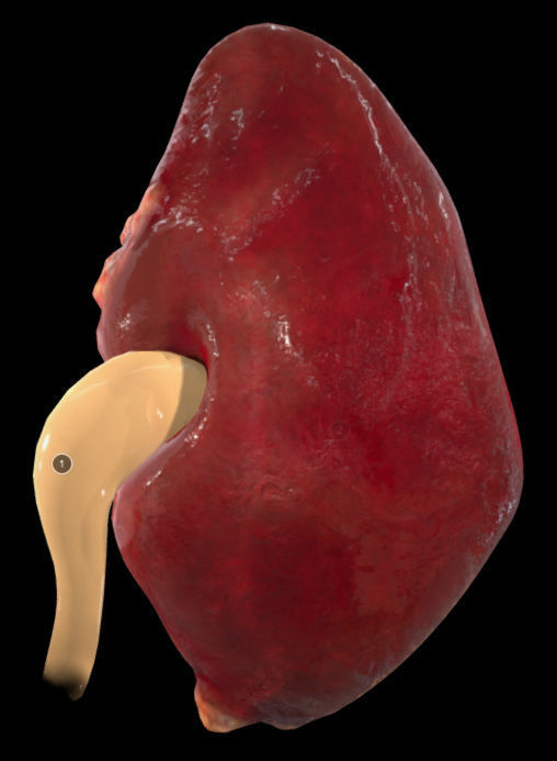 Renal Cell Carcinoma Low-poly 3D model_2