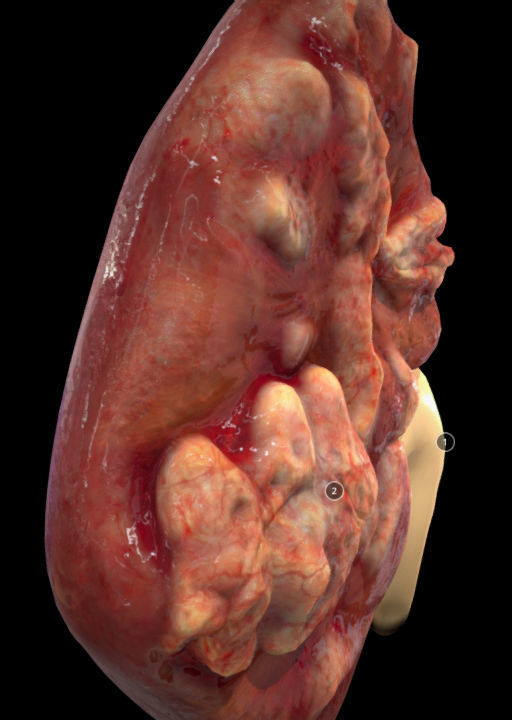 Renal Cell Carcinoma Low-poly 3D model_3